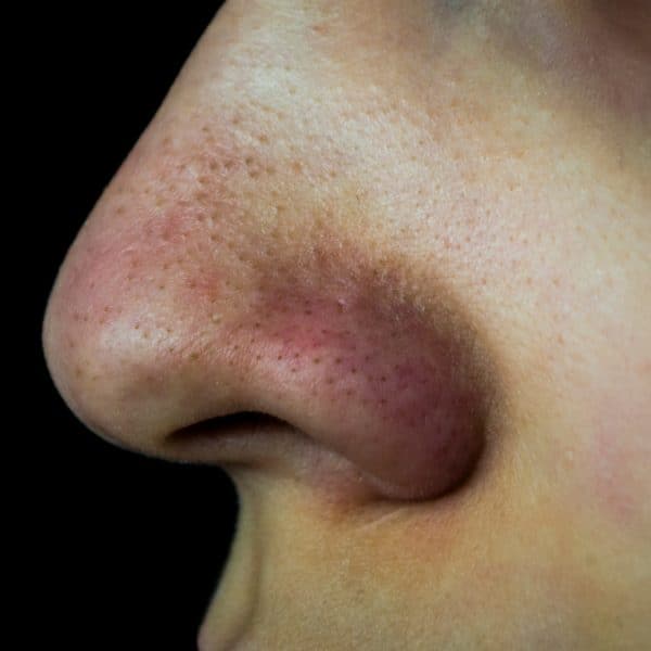 Person suffering from blocked pores and blackheads on their nose