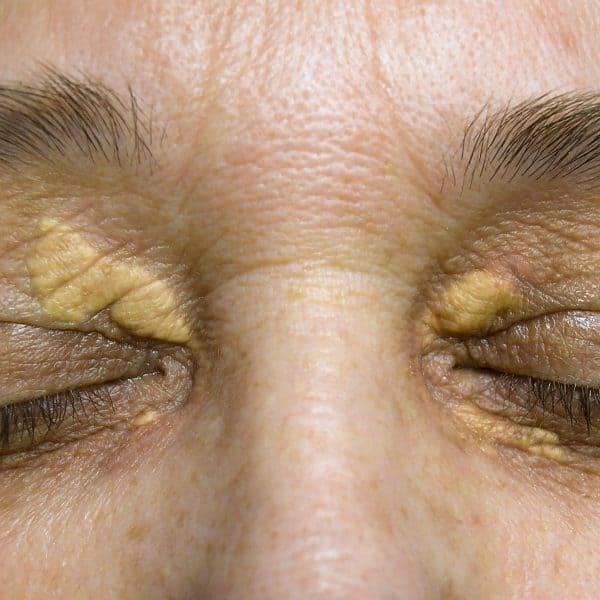 Xanthelasma around a woman's eyes