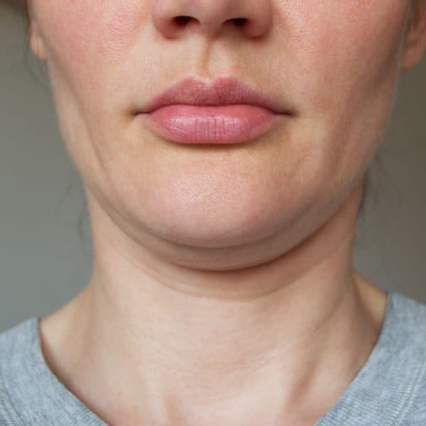 a sporty woman suffering from loss of facial volume caused by gym face