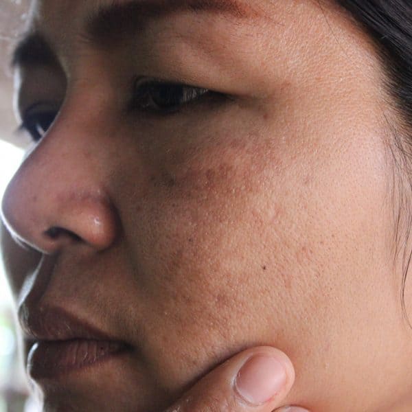 woman with dull skin problems on her face