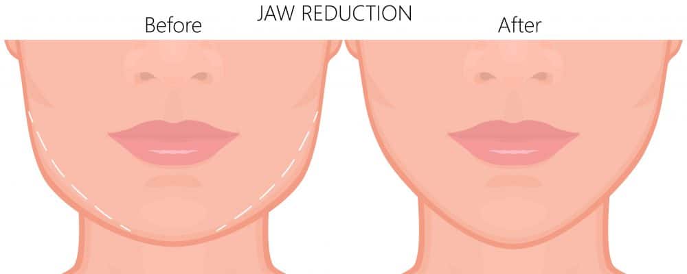 diagram showing non-surgical jaw reshaping and jawline reduction