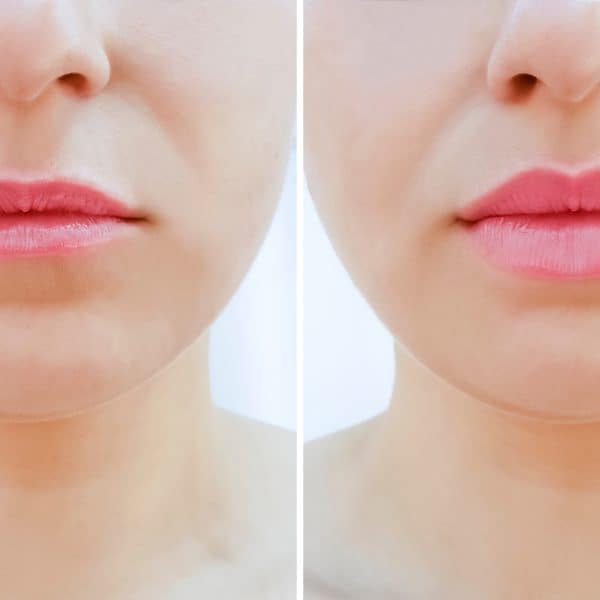 woman with thin lips has lip filler treatment to add volume