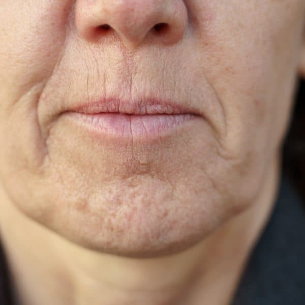 woman with fine lines and wrinkles around her cheeks and mouth