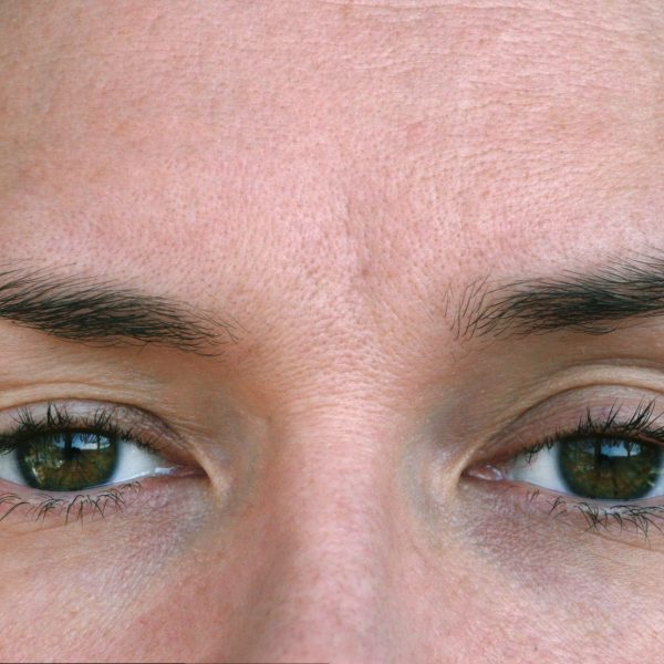 woman with mild hooded or droopy eyelids concerns