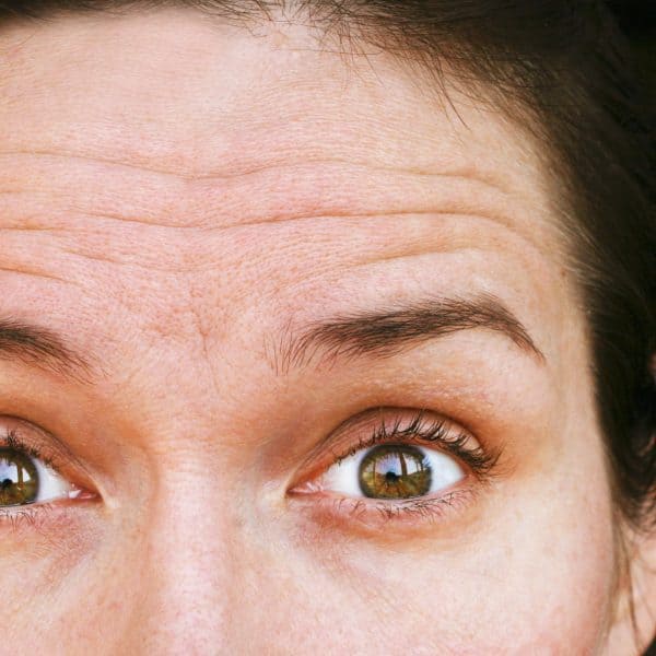 frown lines and forehead wrinkles on a woman in her 30s