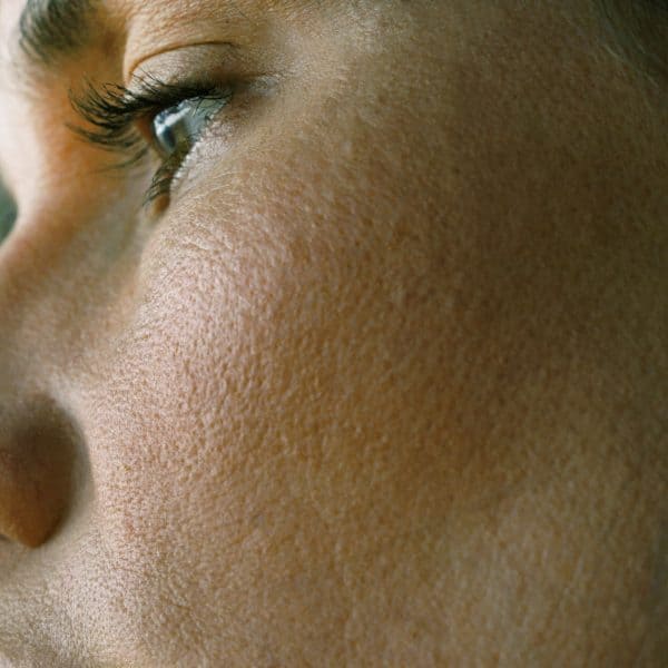 woman with large pores or open pores on their face