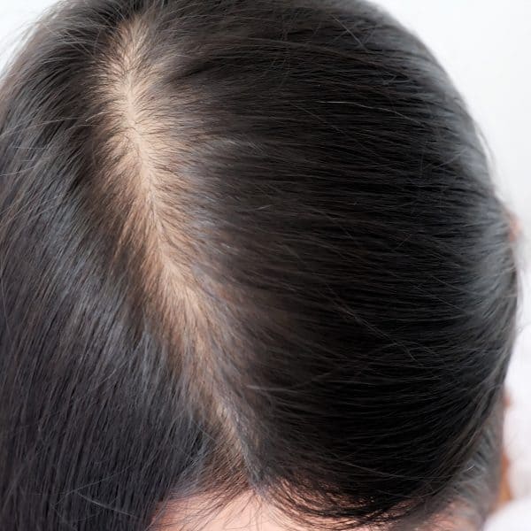 woman with wide part caused by hair loss