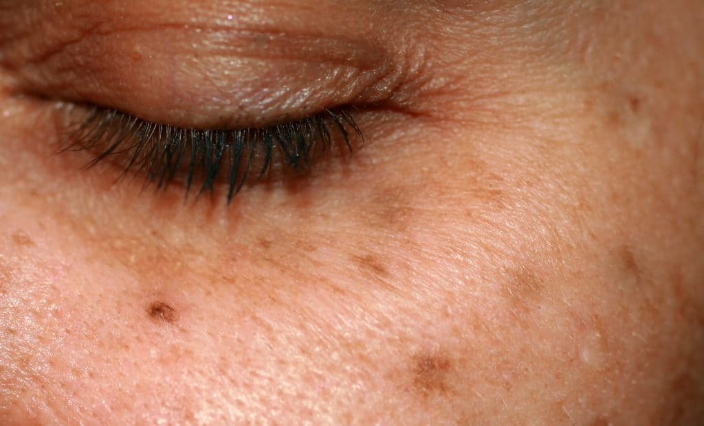 Pigmentation Hyperpigmentation Melasma And Age Spots