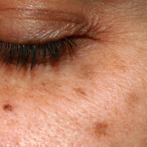 Pigmentation, Hyperpigmentation, Melasma & Age Spots