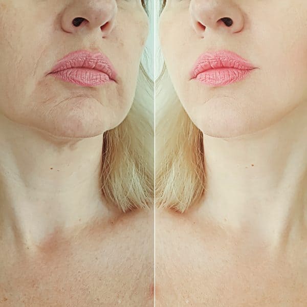 woman suffers from loss of facial volume and contours caused by ageing