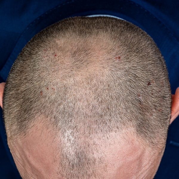 Young man with androgenetic alopecia or male pattern baldness