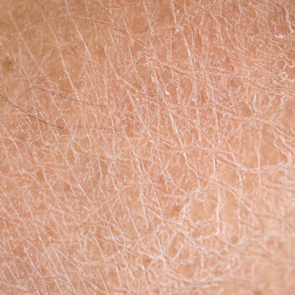 Dry Skin
