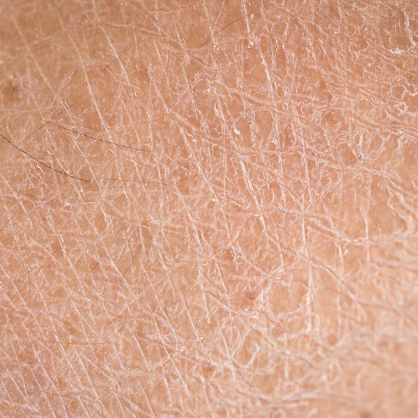 Close-up photo of dry skin