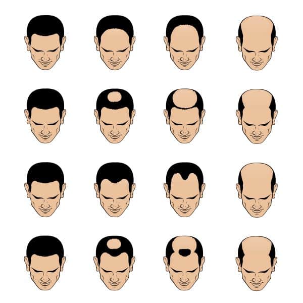 norwood scale for male pattern baldness