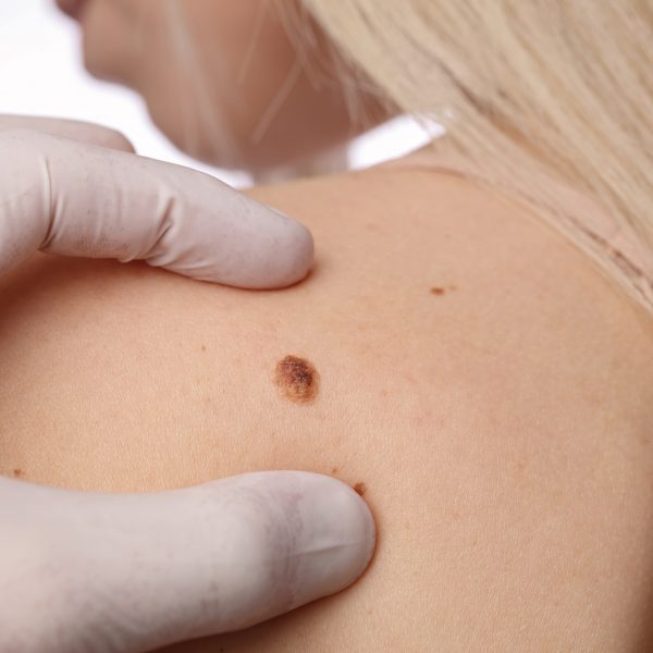 Skin mole on a woman's shoulder is examined by a doctor for mole removal treatment