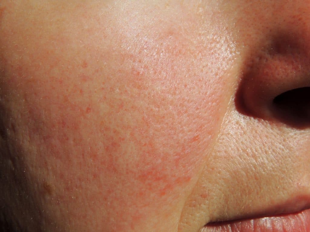 Rosacea Vie Aesthetics