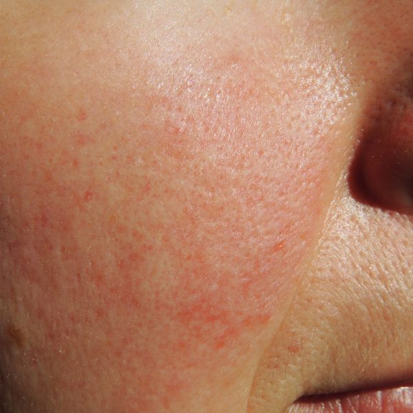 Person suffering from the skin condition rosacea on their cheeks