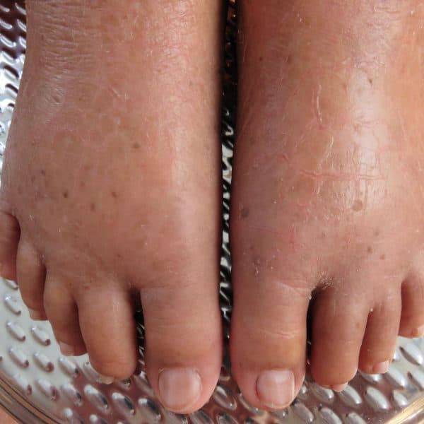 water retention or oedema in a person's feet