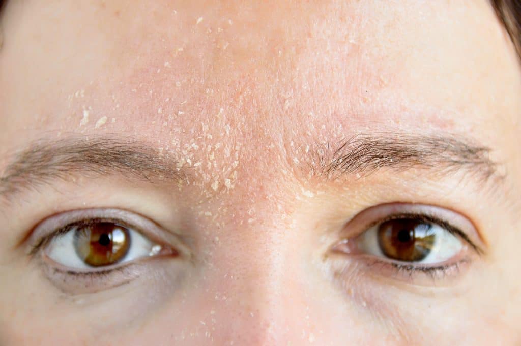 Dry Skin (Face) | Face & Skin Concerns | Vie Aesthetics.