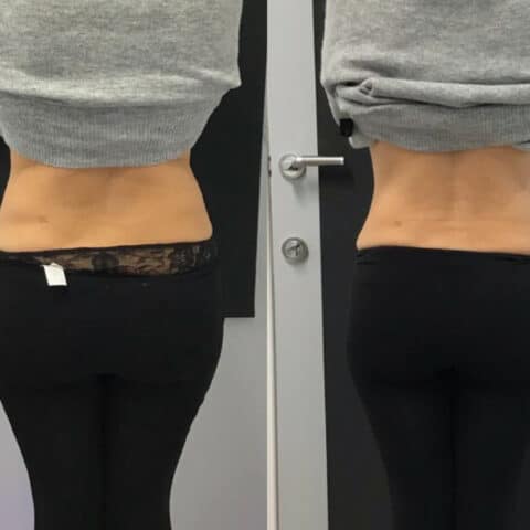 Results of HIFU treatment for toning the abdomen