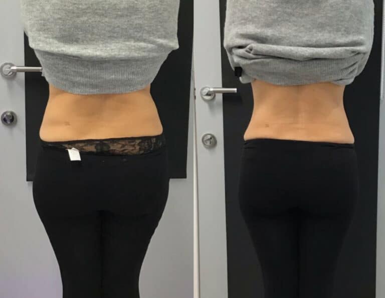 Results of HIFU treatment for toning the abdomen