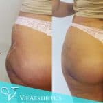 before and after results of bum or butt lift with genefill filler at vie aesthetics