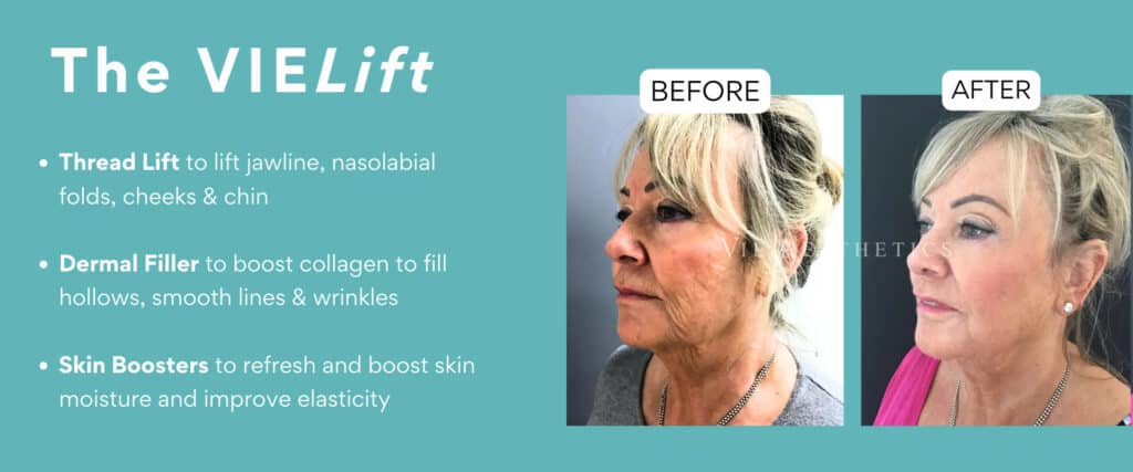 vielift relife dermal filler, thread lift hydrobooster dr liakas vie aesthetics