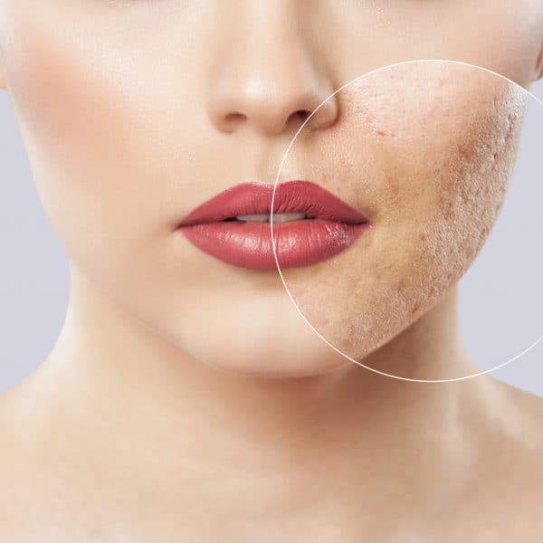 young woman with acne on her face