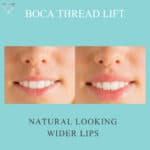 BOCA Lip Lift at Vie Aesthetics