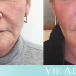 Middle-aged woman shows results of the VIELift non-surgical facelift at Vie Aesthetics