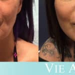 Young woman shows the outcome from a non-surgical VIELift