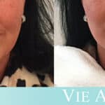 Woman shows the effects of a non-surgical facelift VIELift at Vie Aesthetics