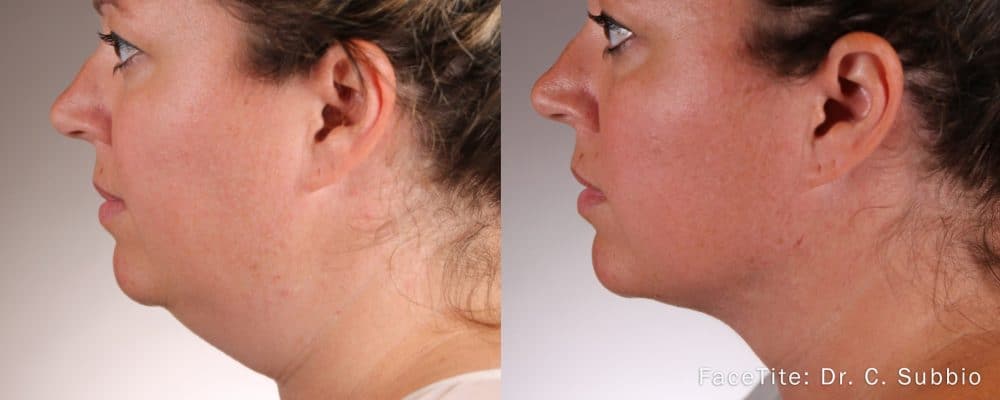 woman showing before and after results on chin and neck with facetite face contouring treatment