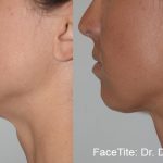 before and after results of a young woman having facetite radio frequency treatment to enhance her chin