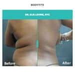 bodytite before and after treatment on back