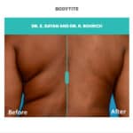 bodytite before and after treatment on back