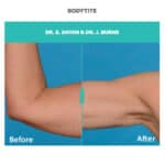 bodytite before and after treatment on arm