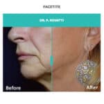 facetite treatment for jaw