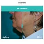 facetite for neck and jaw