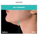 accutite treatment for chin