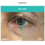 Accutite treatment for eye