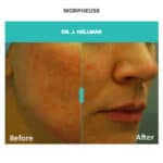 before and after skin and rosacea treatment with morpheus8