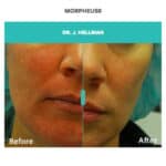 before and after skin pigmentation treatment with morpheus8