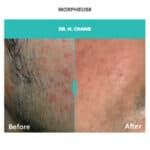 before and after skin treatment on man with morpheus8