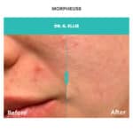 before and after skin and acne treatment with morpheus8