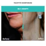 results of Morpheus8 and FaceTite treatment on woman's lower face