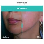 before and after jawline treatment with morpheus8