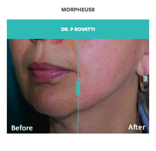 before and after jawline treatment with morpheus8