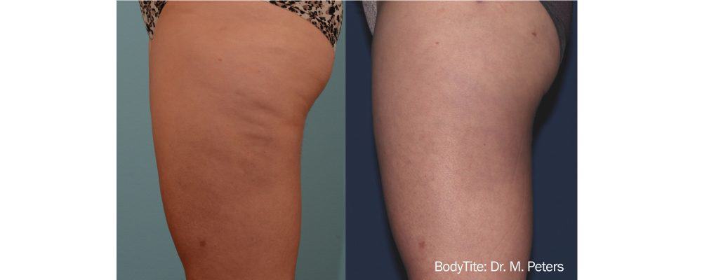 results of a bodytite radio frequency treatment to tighten skin and reduce cellulite in a woman's legs