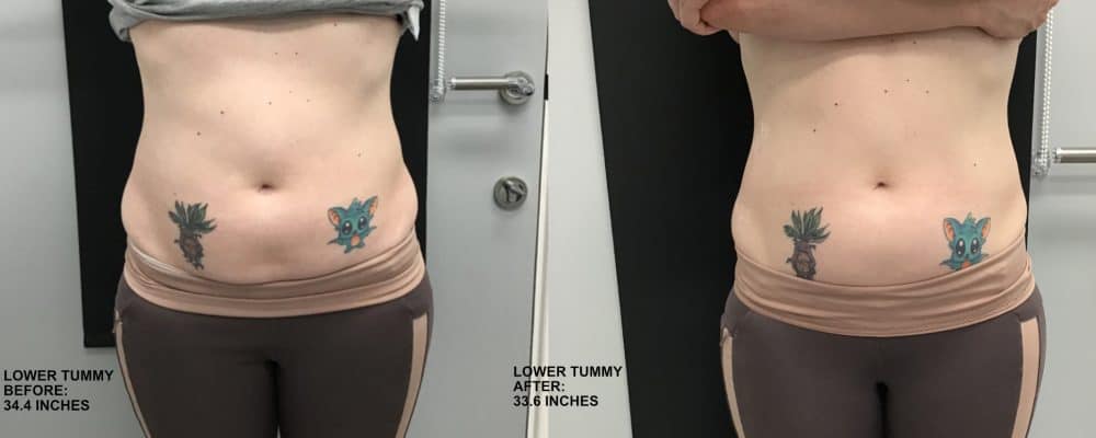 viemax sculpt ems body contouring for lower tummy results